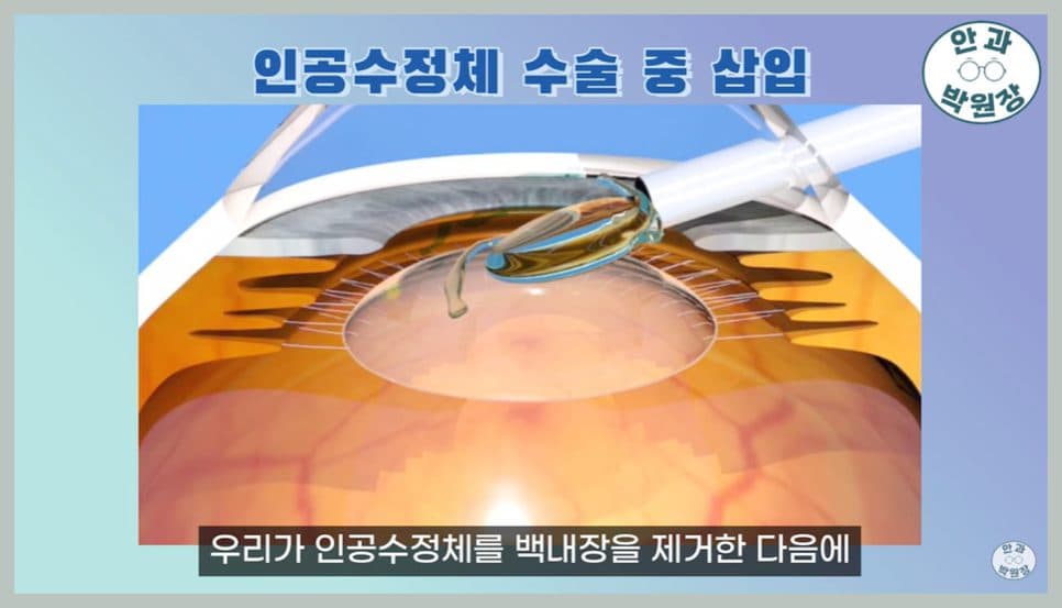 인공수정체 교체·백내장 재수술 가능한 시기와 다초점 렌즈 적응 기간 구분 관련 이미지