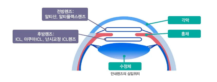 안내렌즈 삽입 위치 — 각막·홍채·수정체 단면 구조