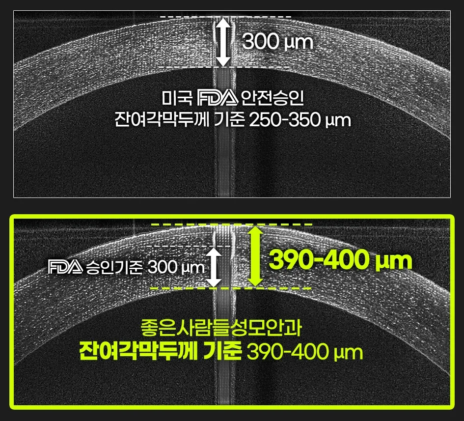 FDA 기준 250~350μm 대비 본원 잔여각막두께 390~400μm 비교